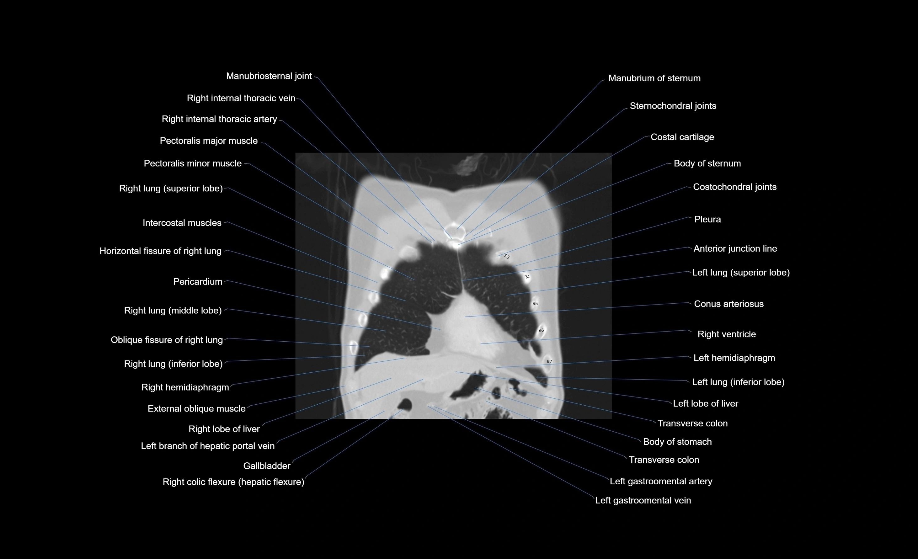 CT chest (thorax) labelled coronal cross sectional anatomy radiology image-00094.webp